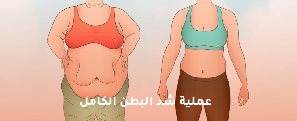 عملية شد البطن الكامل